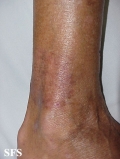 leprosy tuberculoid
