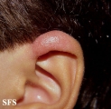 leprosy tuberculoid