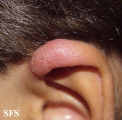 leprosy tuberculoid