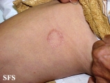 leprosy tuberculoid