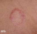 leprosy tuberculoid
