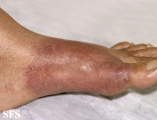 leprosy tuberculoid