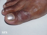 leprosy tuberculoid