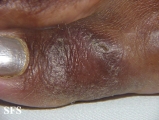 leprosy tuberculoid