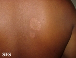 leprosy tuberculoid
