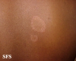 leprosy tuberculoid