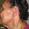 leprosy tuberculoid
