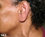 leprosy tuberculoid