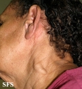 leprosy tuberculoid