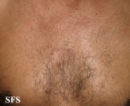 leprosy tuberculoid
