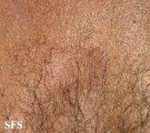 leprosy tuberculoid