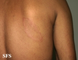 leprosy tuberculoid