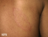 leprosy tuberculoid