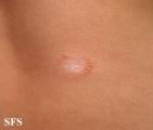 leprosy tuberculoid