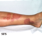 leprosy tuberculoid