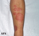leprosy tuberculoid