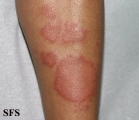 leprosy tuberculoid