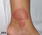 leprosy tuberculoid