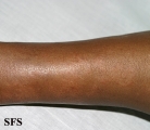 leprosy tuberculoid
