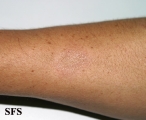 leprosy tuberculoid