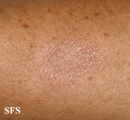 leprosy tuberculoid