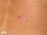 leprosy tuberculoid