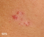 leprosy tuberculoid