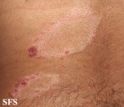 leprosy tuberculoid