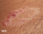 leprosy tuberculoid