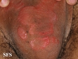 leprosy tuberculoid