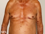 leprosy tuberculoid