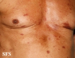 leprosy tuberculoid