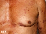 leprosy tuberculoid