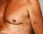 leprosy tuberculoid