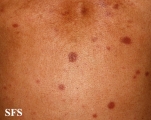 leprosy tuberculoid