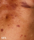 leprosy tuberculoid