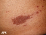 leprosy tuberculoid