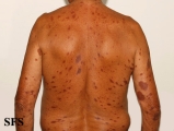 leprosy tuberculoid