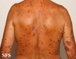 leprosy tuberculoid
