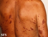 leprosy tuberculoid