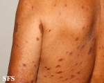 leprosy tuberculoid