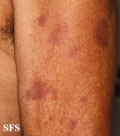 leprosy tuberculoid