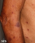 leprosy tuberculoid