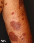 leprosy tuberculoid