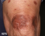leprosy tuberculoid