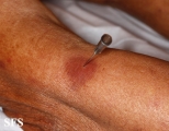 leprosy tuberculoid