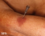 leprosy tuberculoid