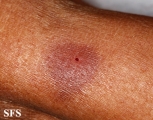leprosy tuberculoid