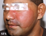 leprosy tuberculoid