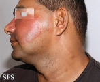 leprosy tuberculoid